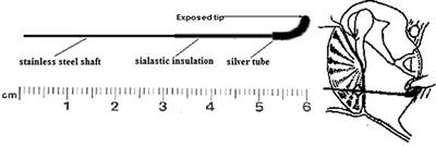The Clinical Uses of Electrocochleography